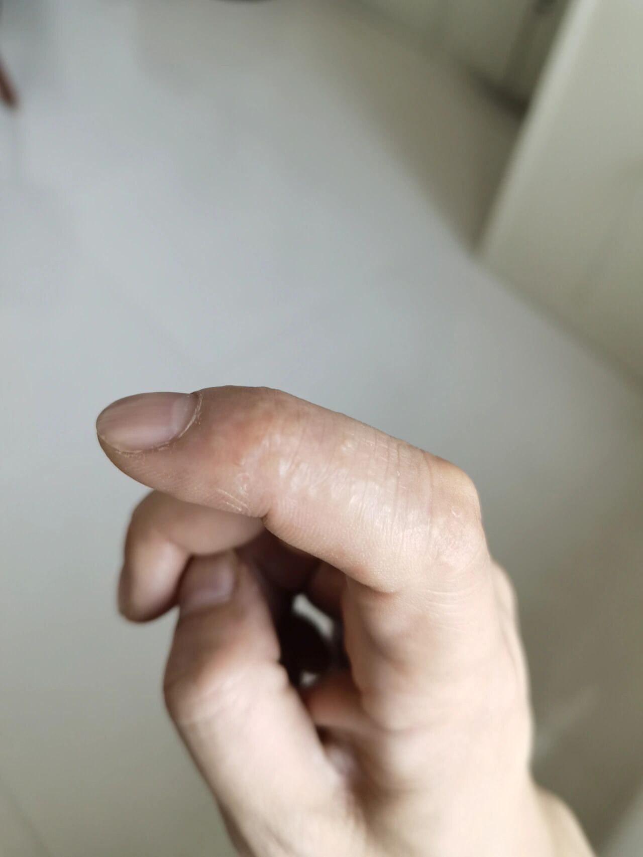 手指上起小水泡怎么办