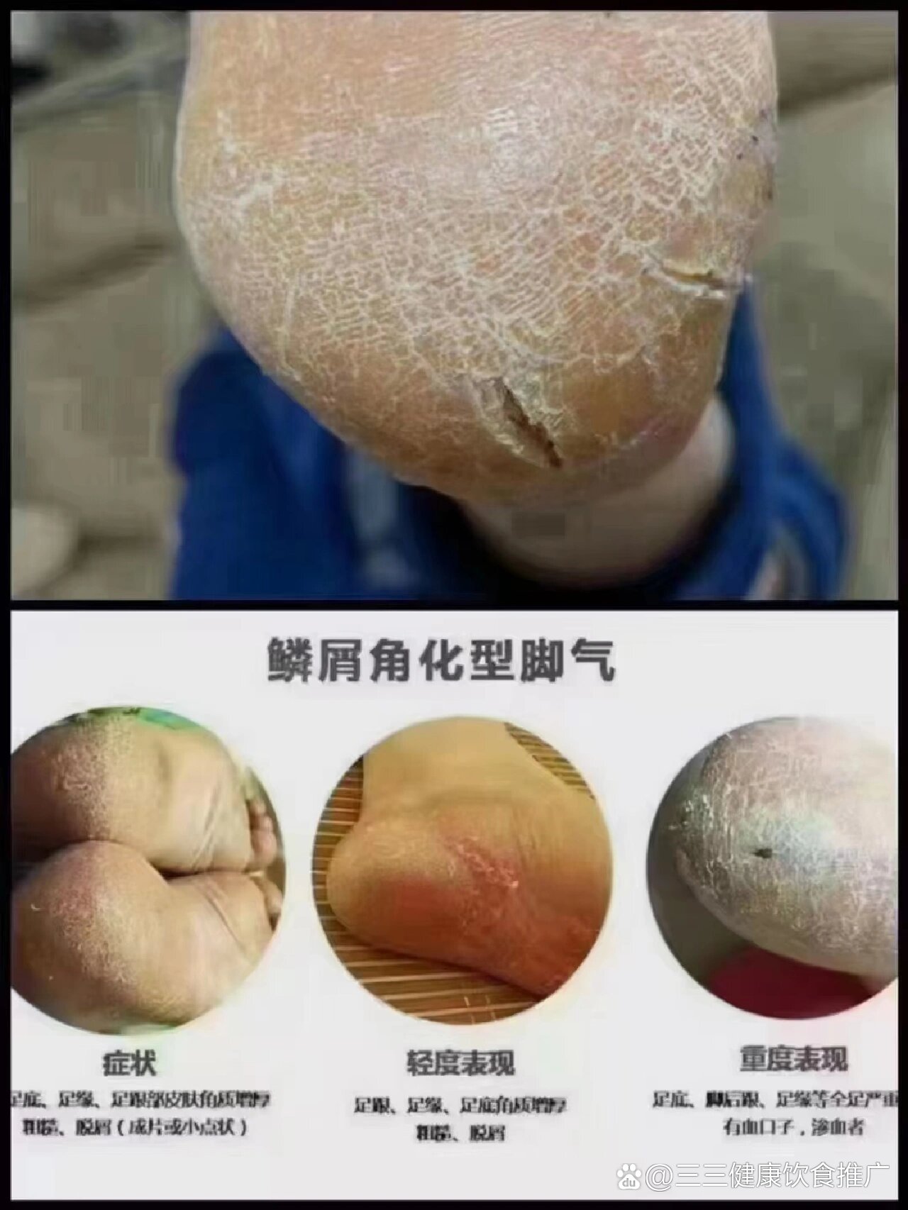 角化病是一种什么病,如何治疗