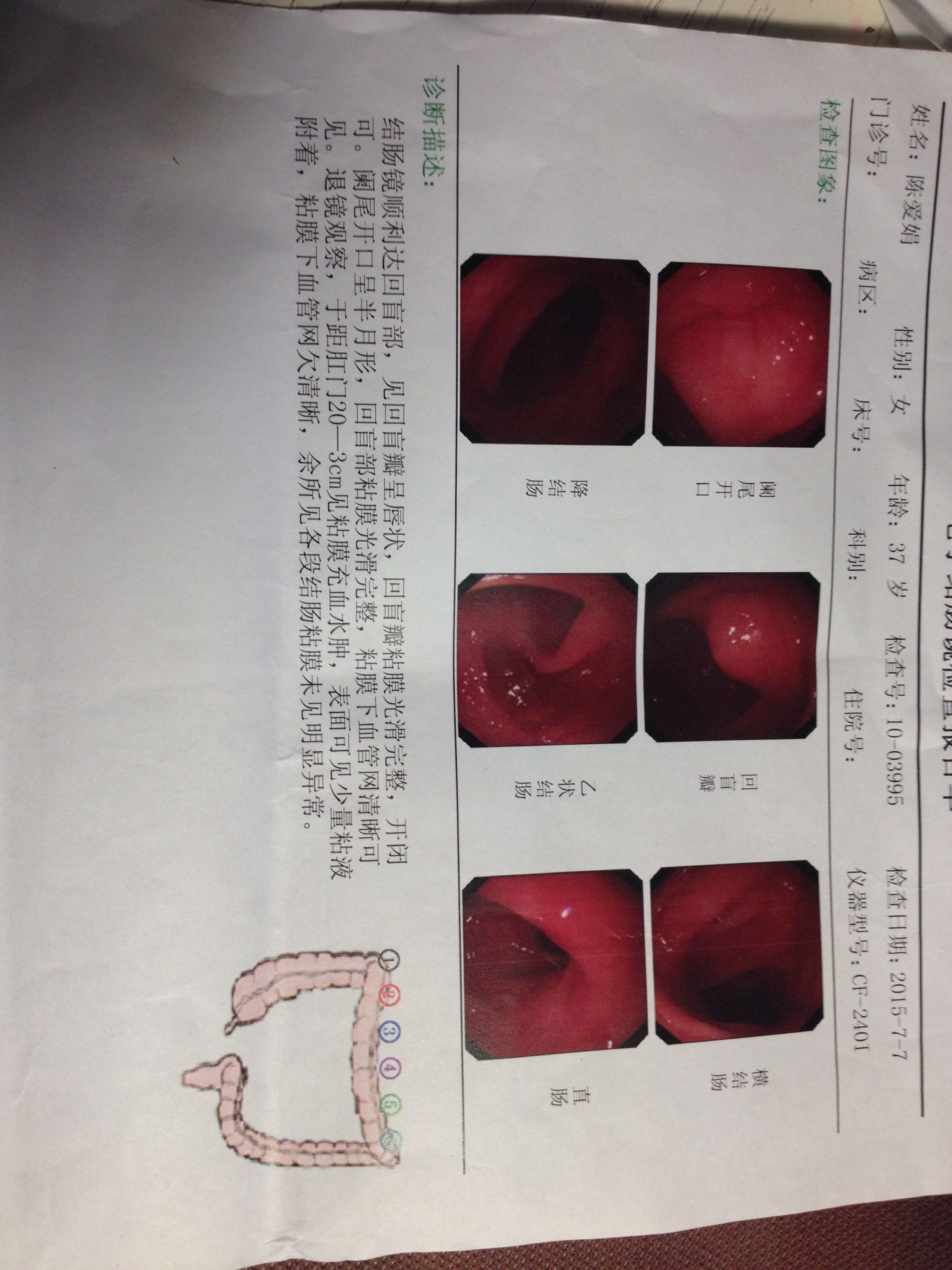 慢性直肠炎有哪些症状