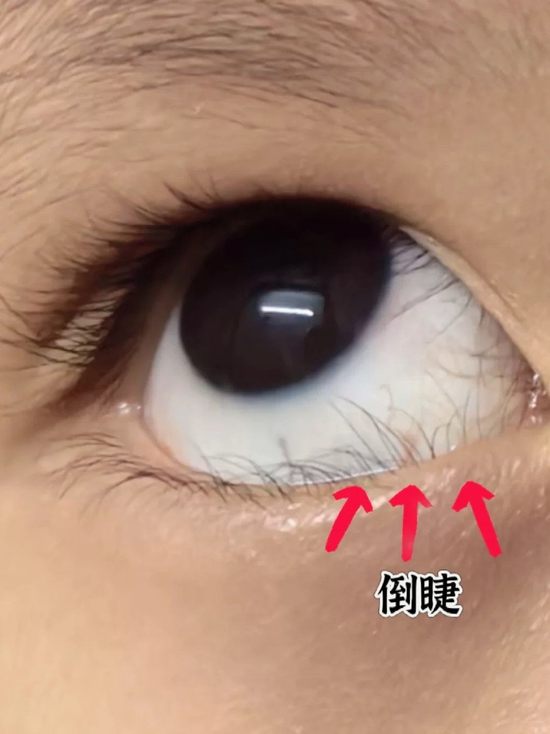 孩子倒睫怎么办