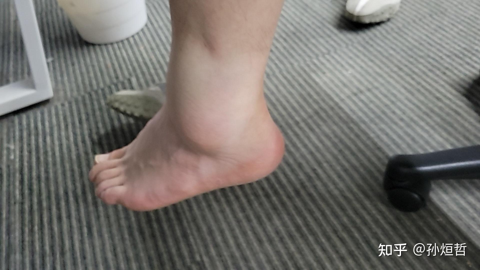 打球崴脚,脚踝肿了,怎么办.