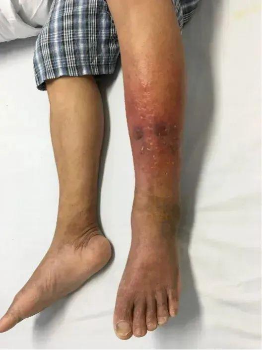 败血症的症状有哪些