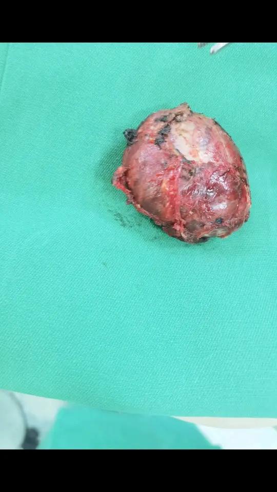 甲状腺滤泡囊肿容易治吗