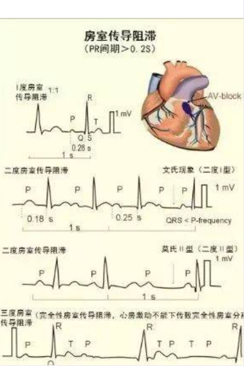 三度房室传导阻滞的心电图特征