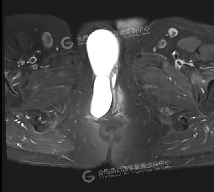 外阴长了一个硬包,怎么办