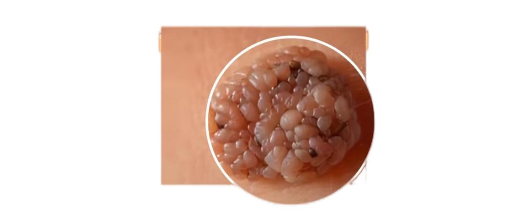 尖锐湿疣3个月没复发