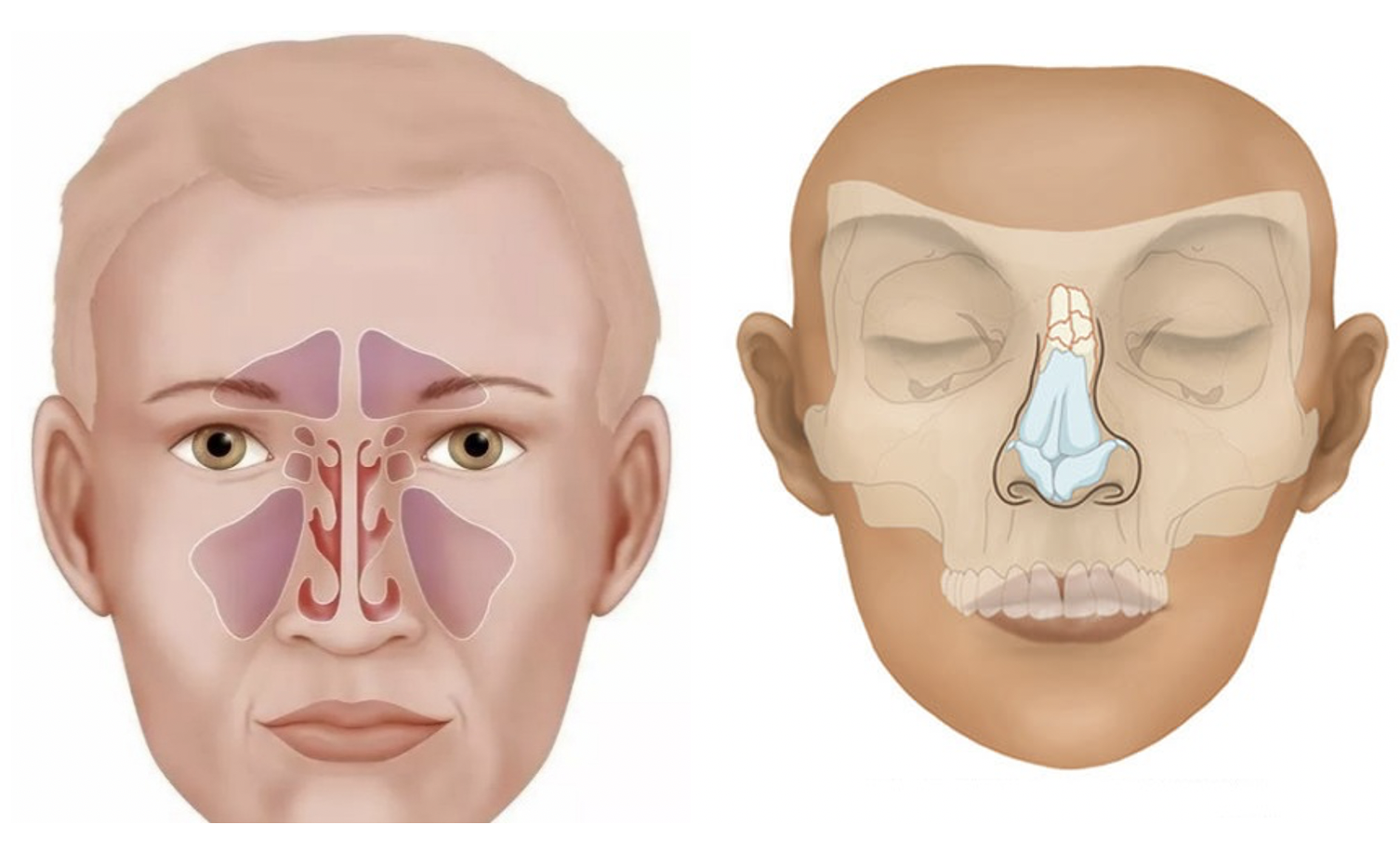 鼻梁骨折怎么恢复