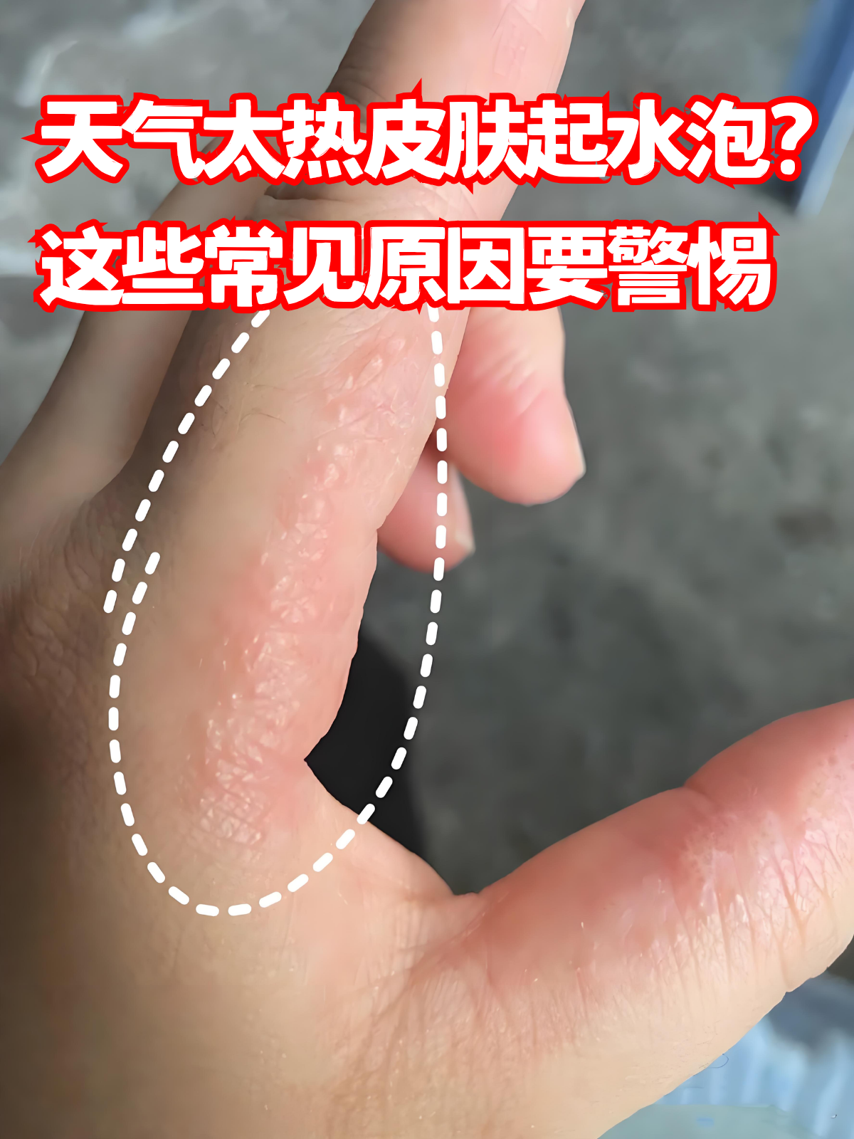 身上一热就发痒是怎么回事