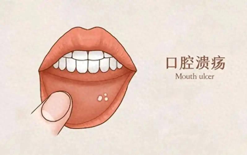 什么是口腔溃疡