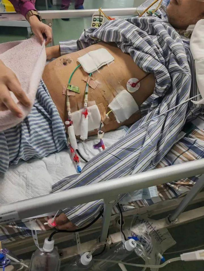 是什么引起腹腔积水