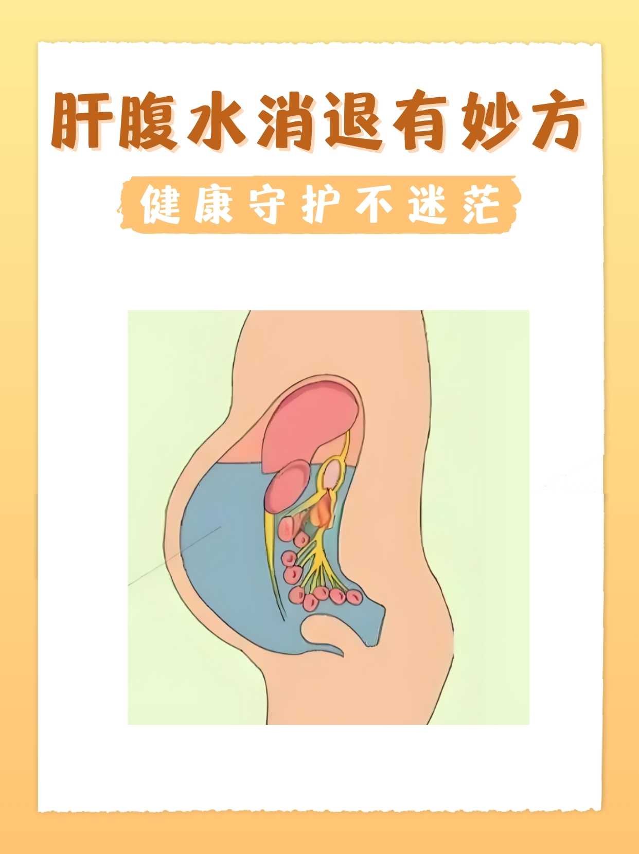 是什么引起腹腔积水