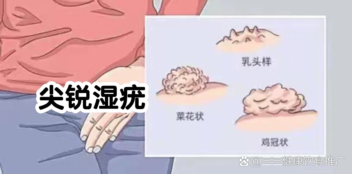 尖锐湿疣可以彻底治愈吗?