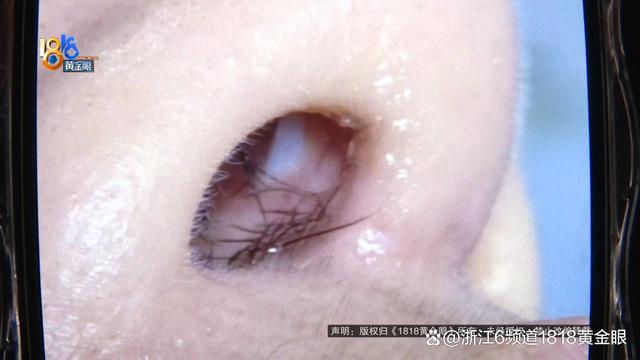 鼻孔内长了个白色的小疙瘩