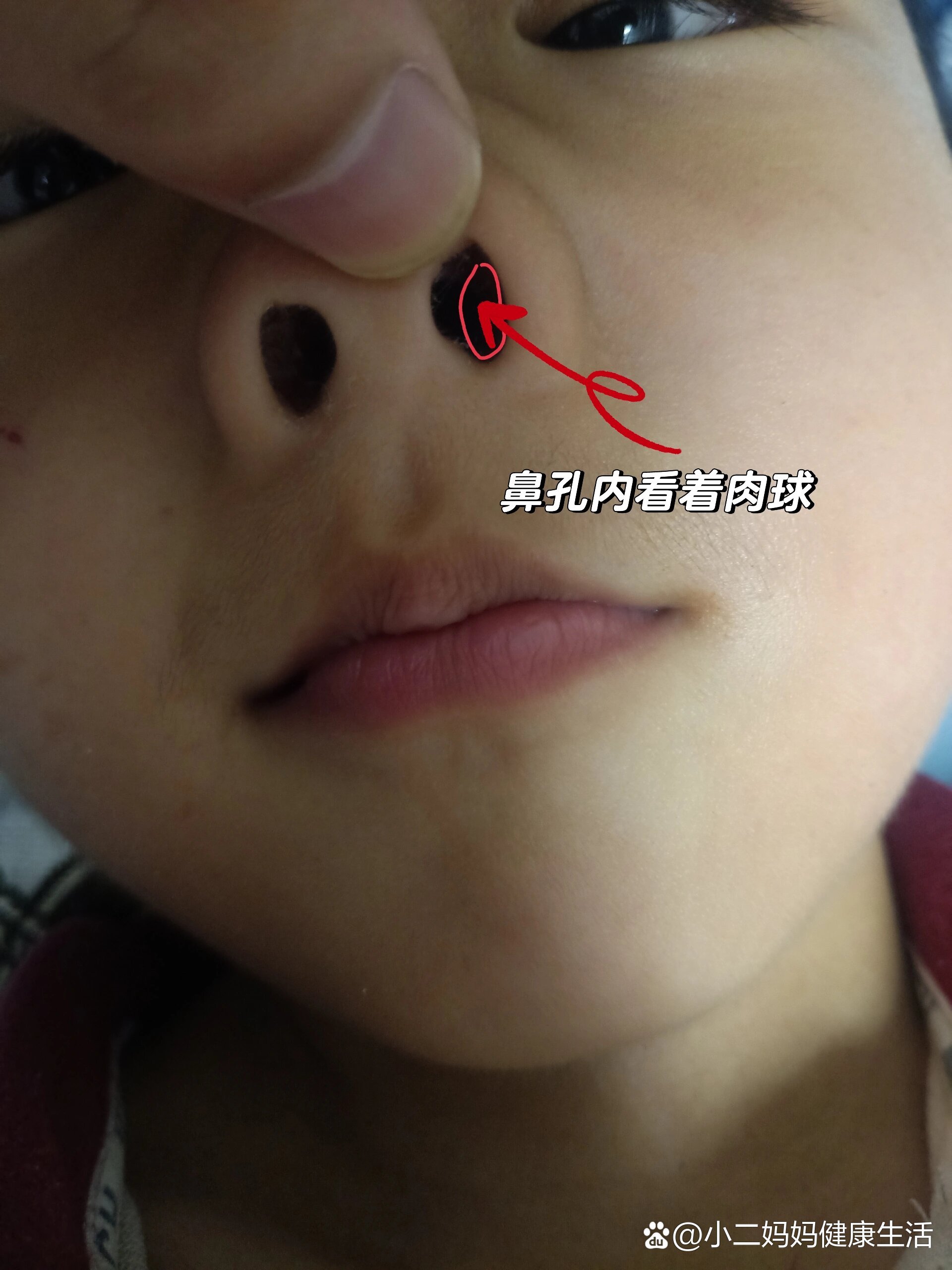 鼻孔内长了个白色的小疙瘩