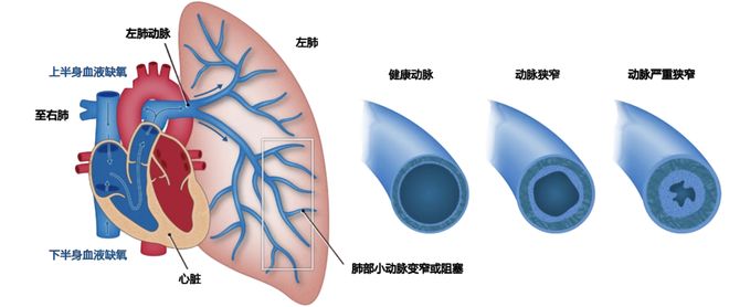 什么是肺动脉高压?