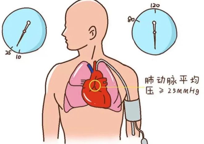 什么是肺动脉高压?