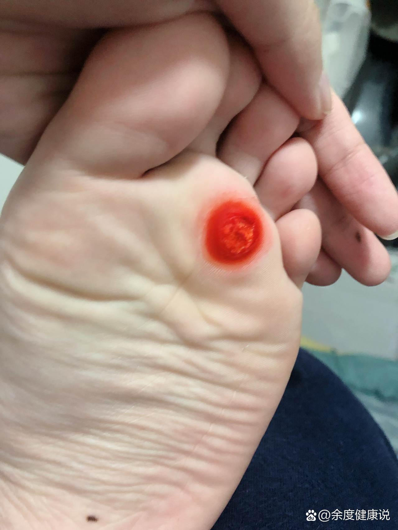 脚上长鸡眼怎么办?