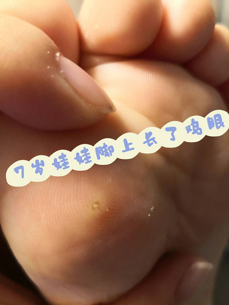 脚上长鸡眼怎么办?