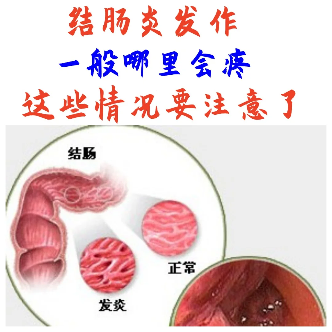 早期结肠炎的症状有哪些