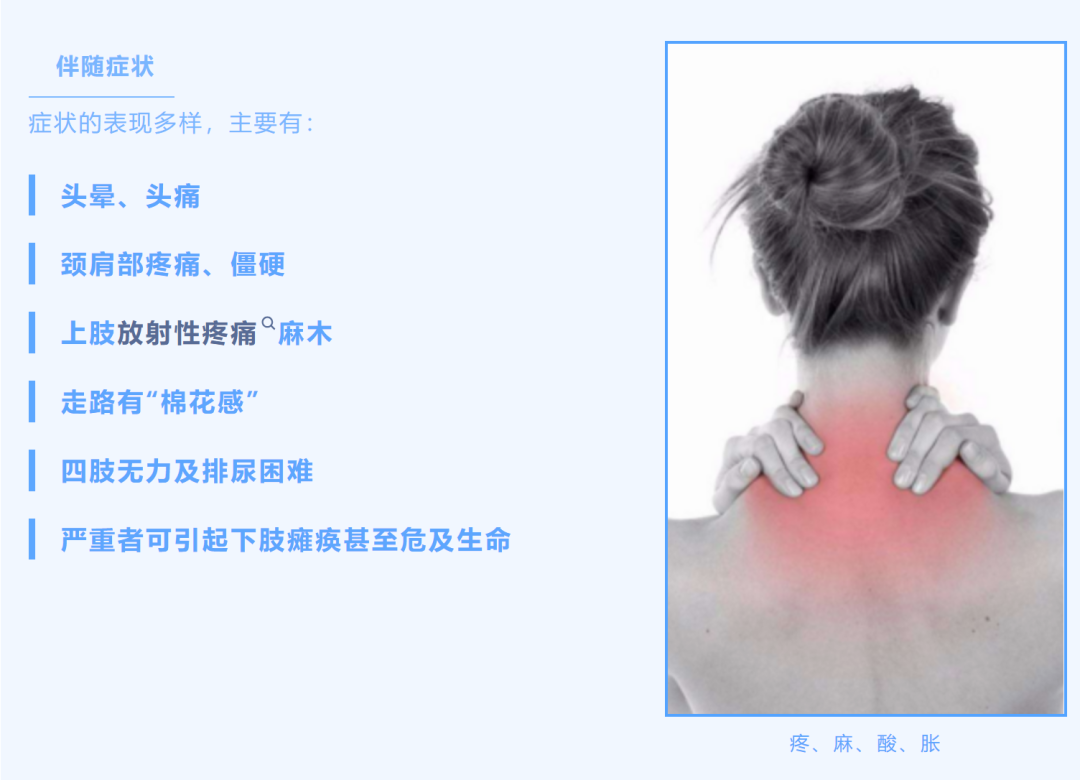 颈椎间盘突出症的自我疗法