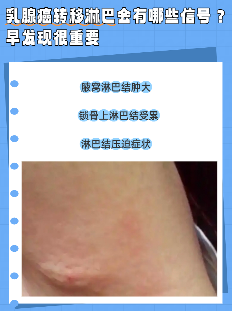 乳腺癌淋巴转移怎样办