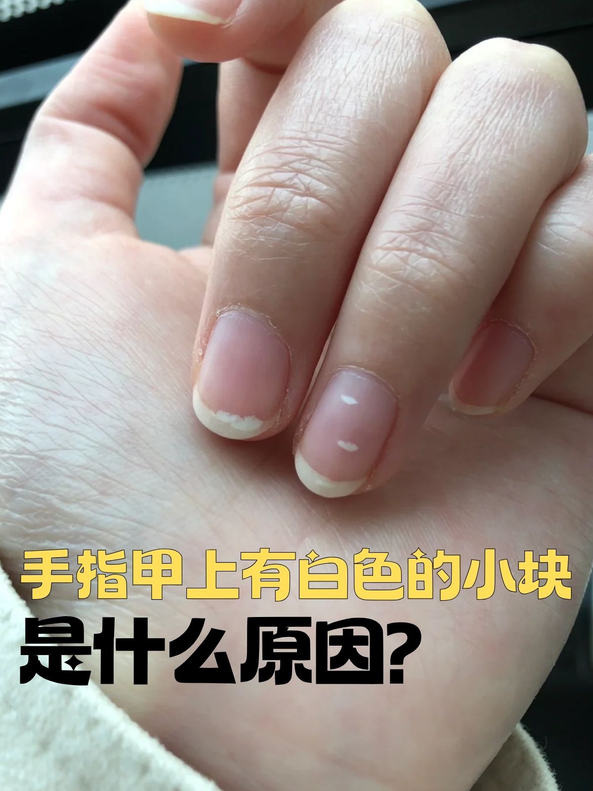 手指甲有白色斑点怎么办