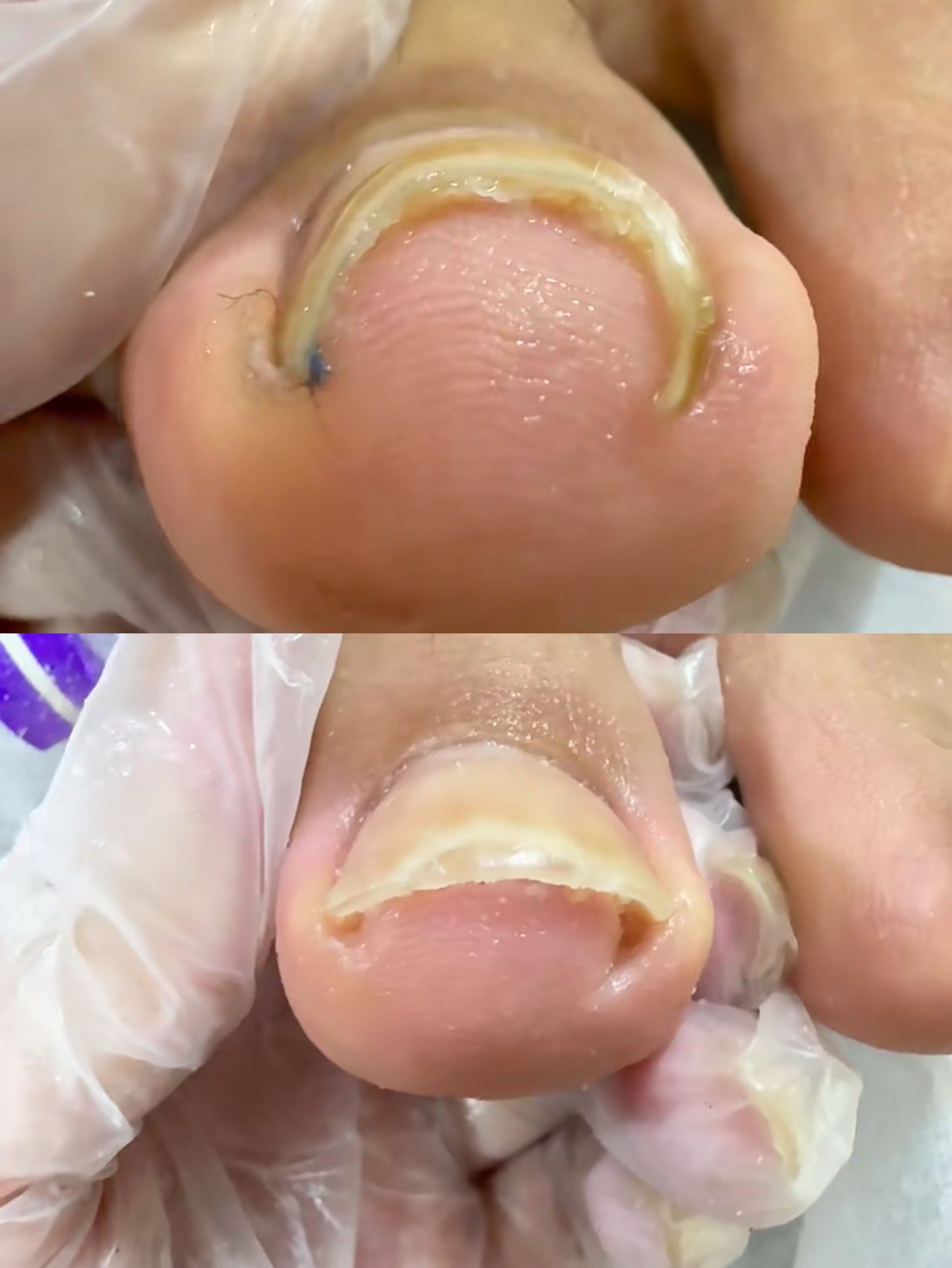 脚趾甲长到肉里面怎么办