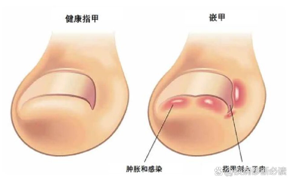 脚趾甲长到肉里面怎么办
