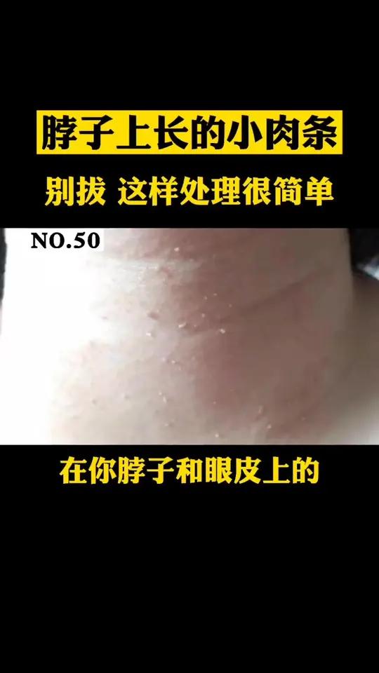 脖子上丝状疣怎么办