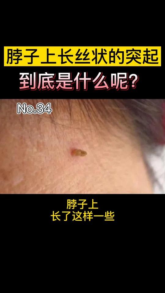 脖子上丝状疣怎么办