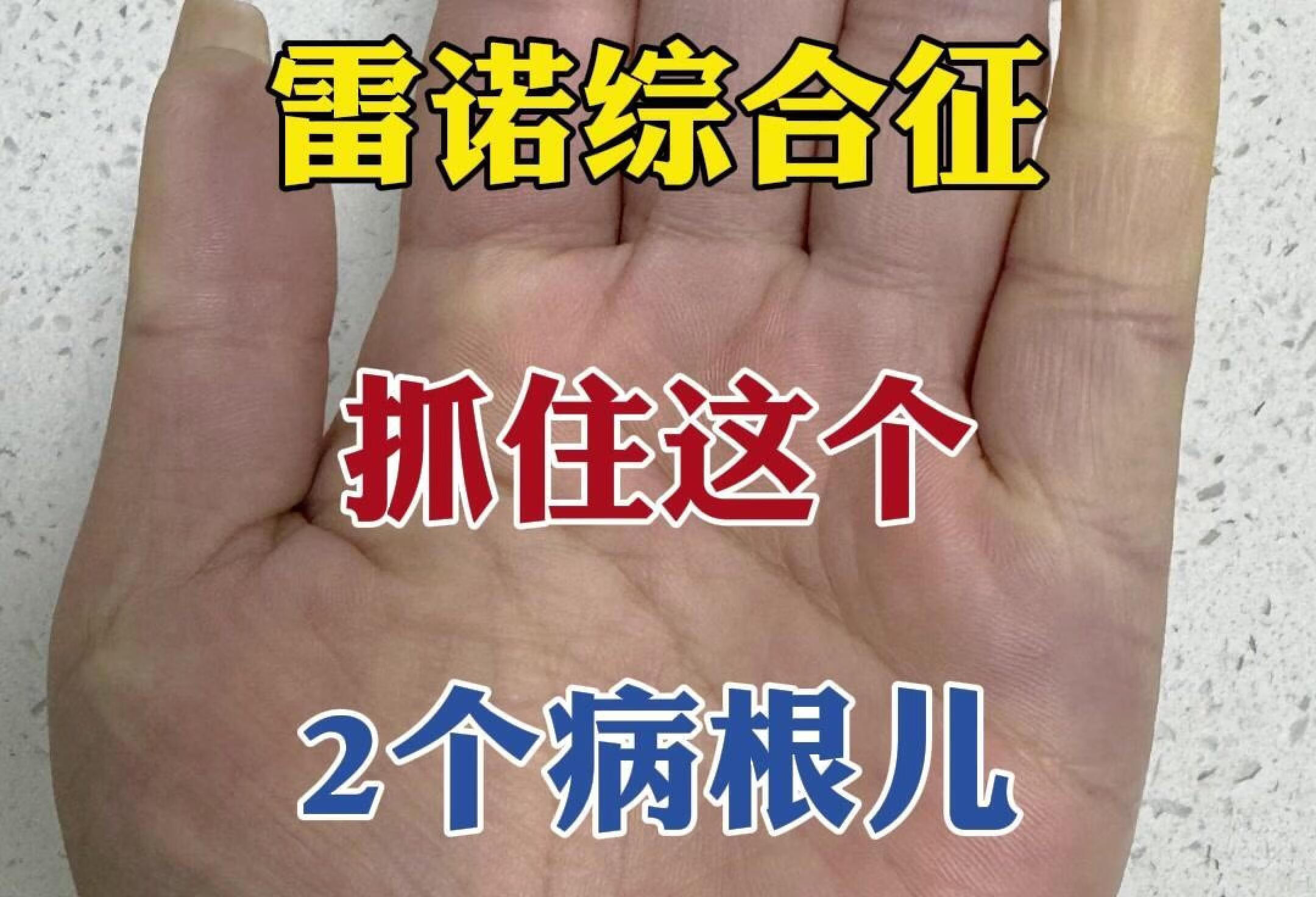 雷诺氏综合症的病因