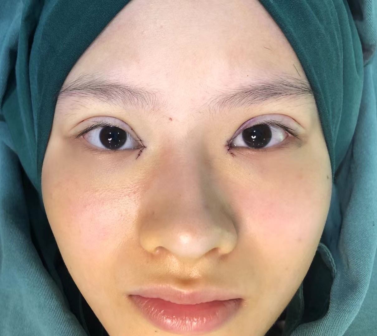 开眼角美容术