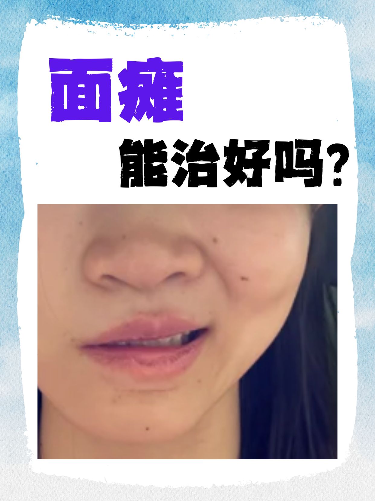 面瘫什么原因导致的
