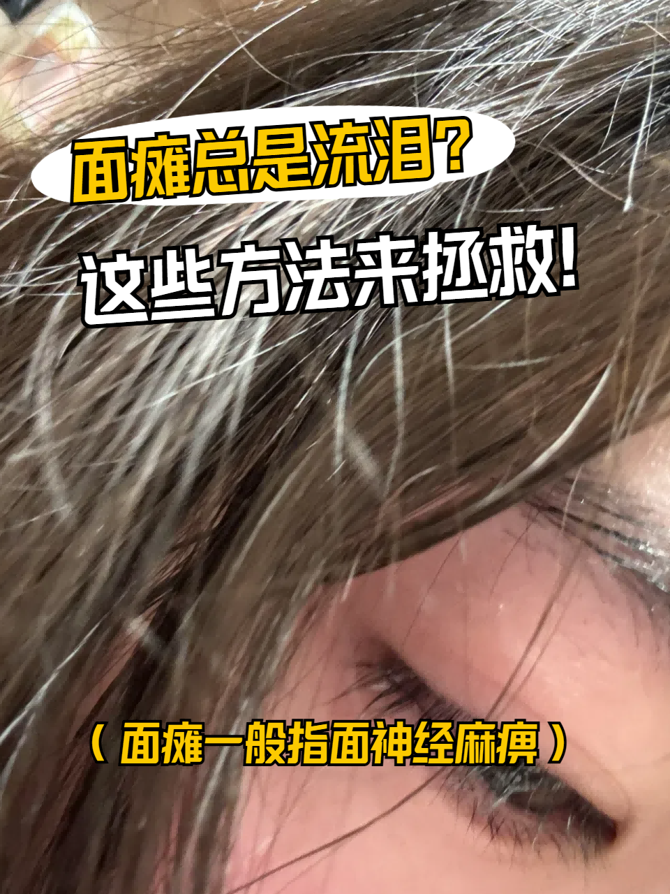 面瘫什么原因导致的