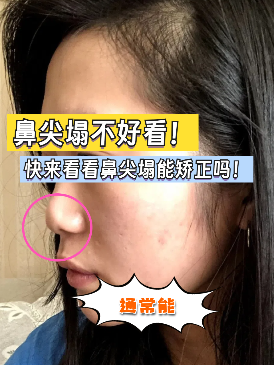 鼻子塌怎么变挺