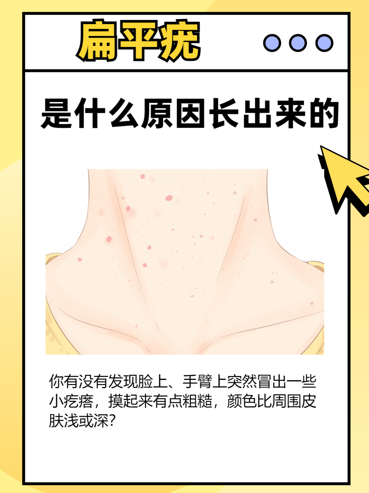 扁平疣是什么?