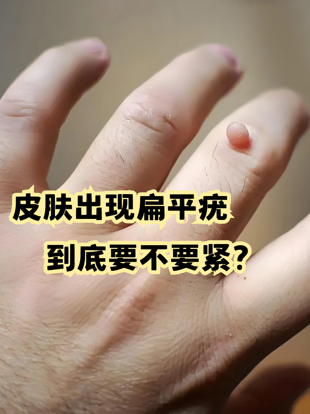 扁平疣是什么?