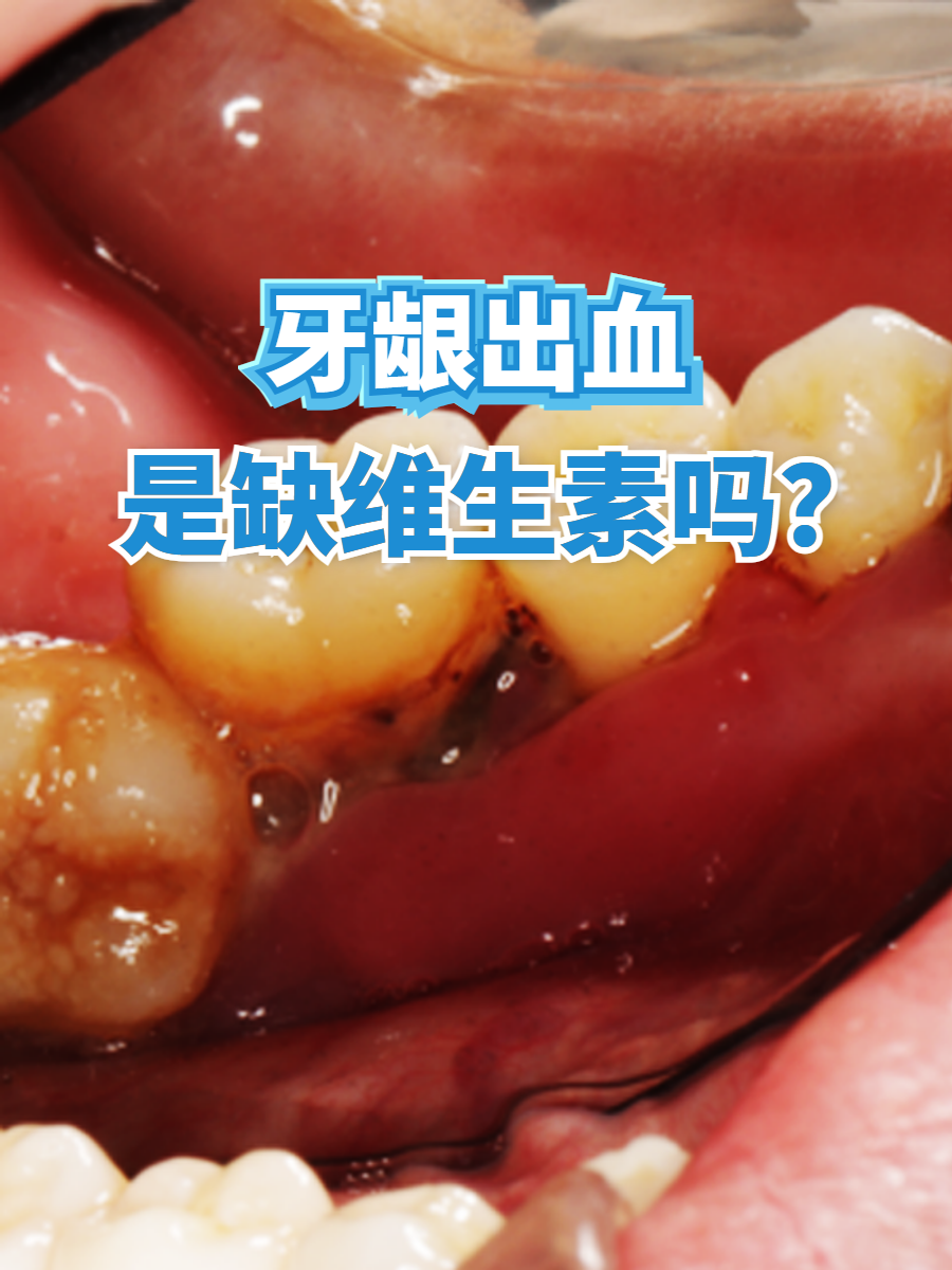 牙龈出血缺什么???