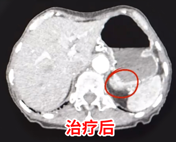 胆囊癌晚期死前症状有什么呢