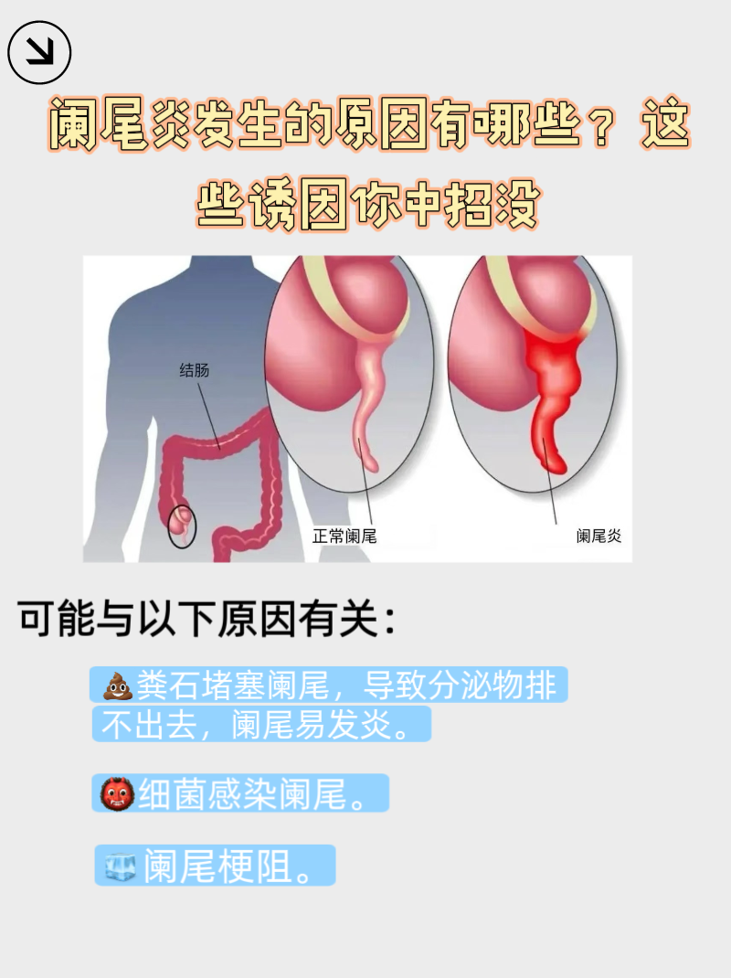 阑尾炎是由什么原因引起的