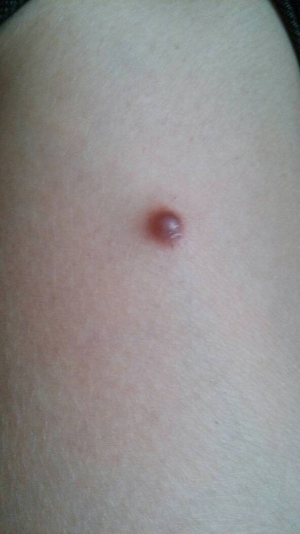 大腿上长了一个硬疙瘩