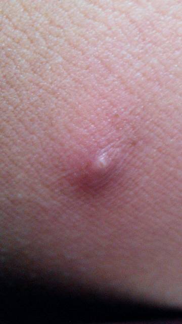 大腿上长了一个硬疙瘩