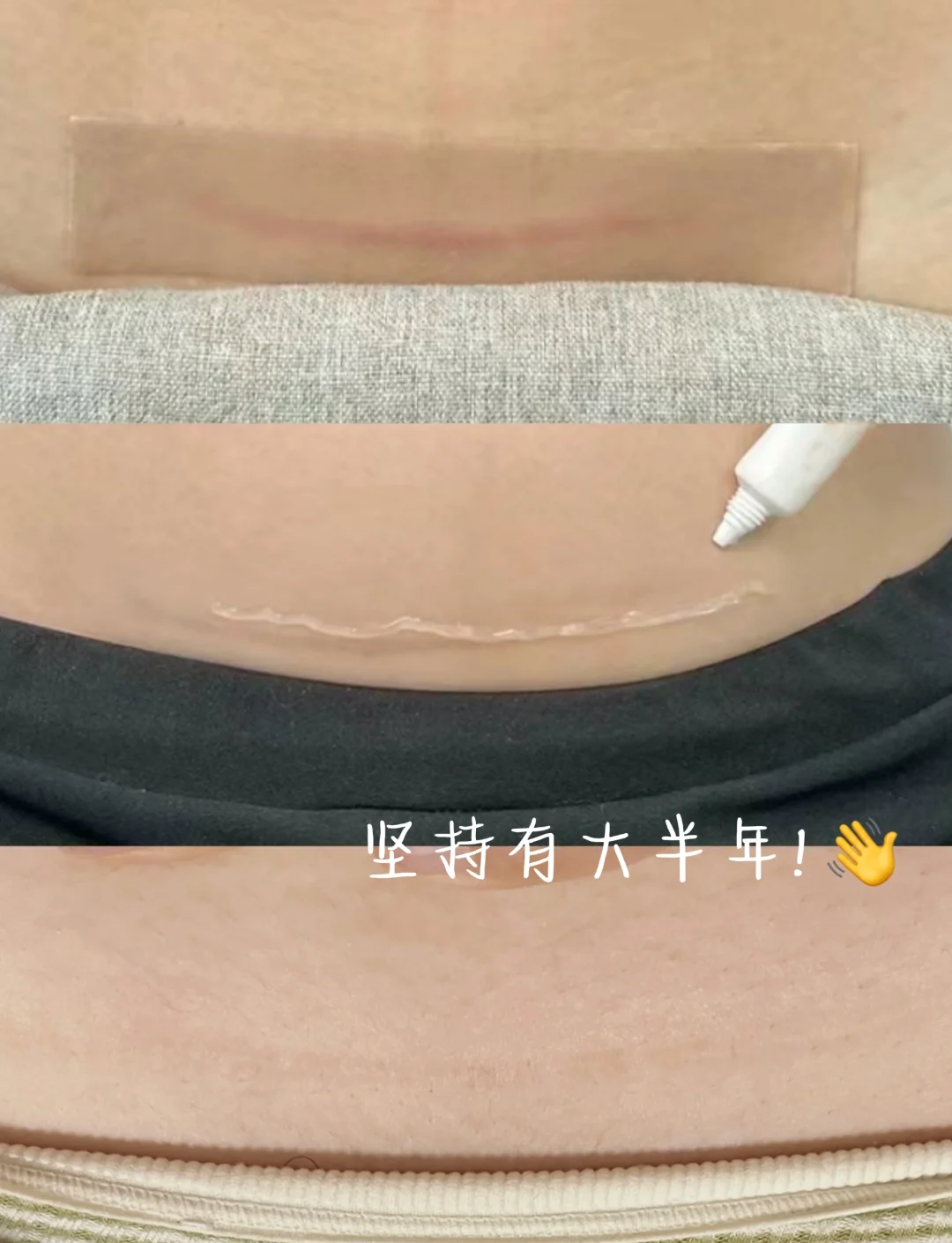 侧切刀口多久可以好?