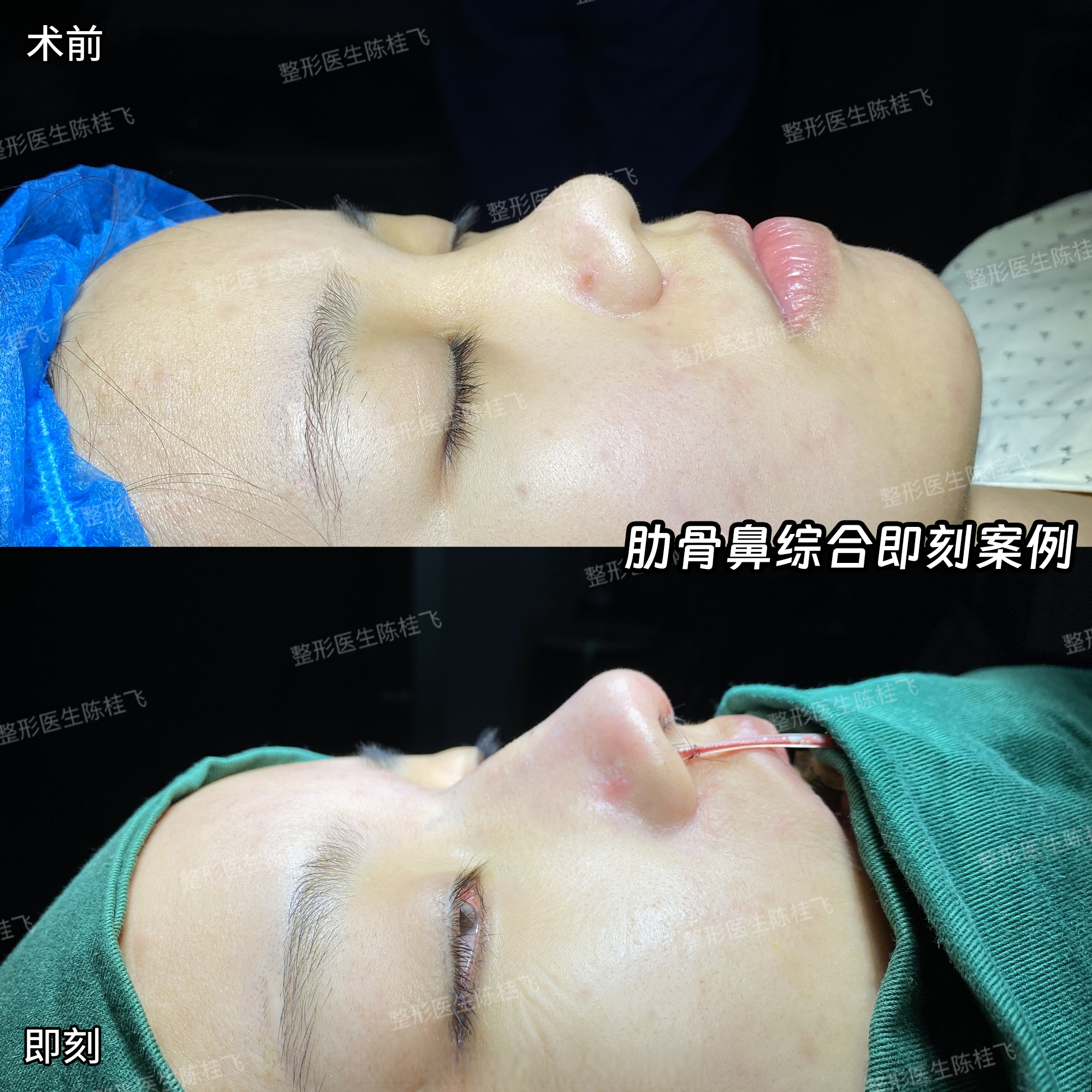 鼻小柱延长是怎么回事?