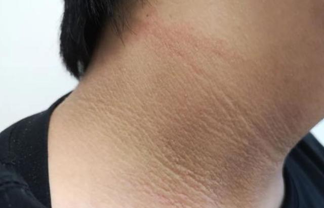 黑棘皮病怎么能好颜色怎么能白