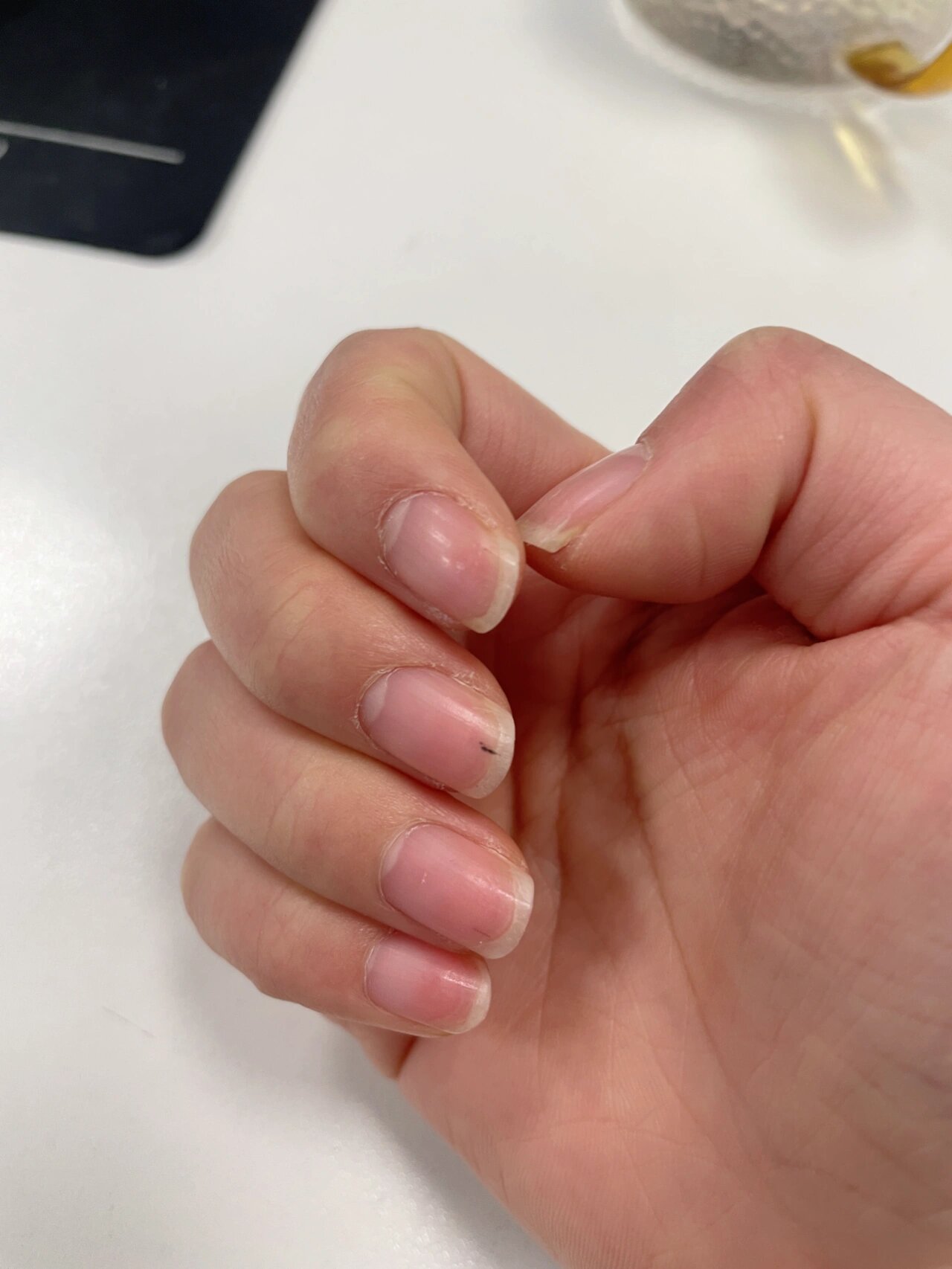 指甲里有黑线是什么东西?