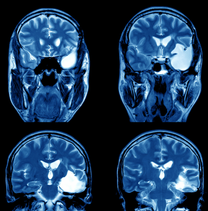 轻微脑震荡严重吗