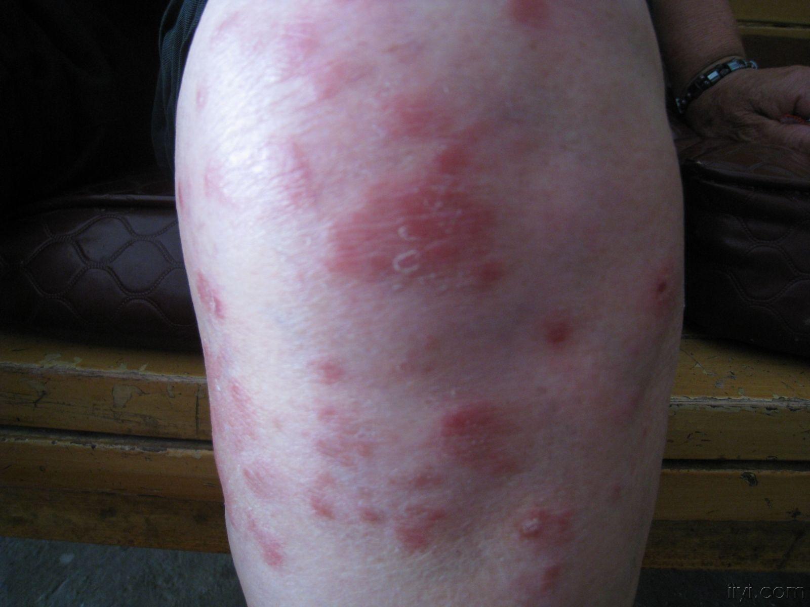 吃了皮肤病血毒胶囊三四天的样子