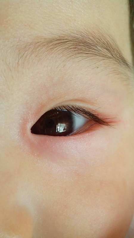宝宝眼睛发红有眼屎