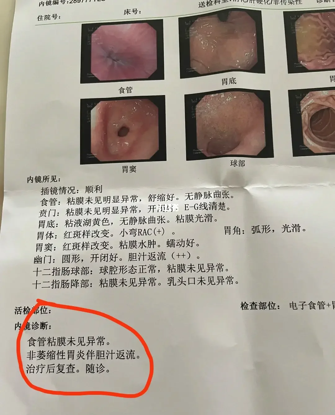 胃病怎么检查